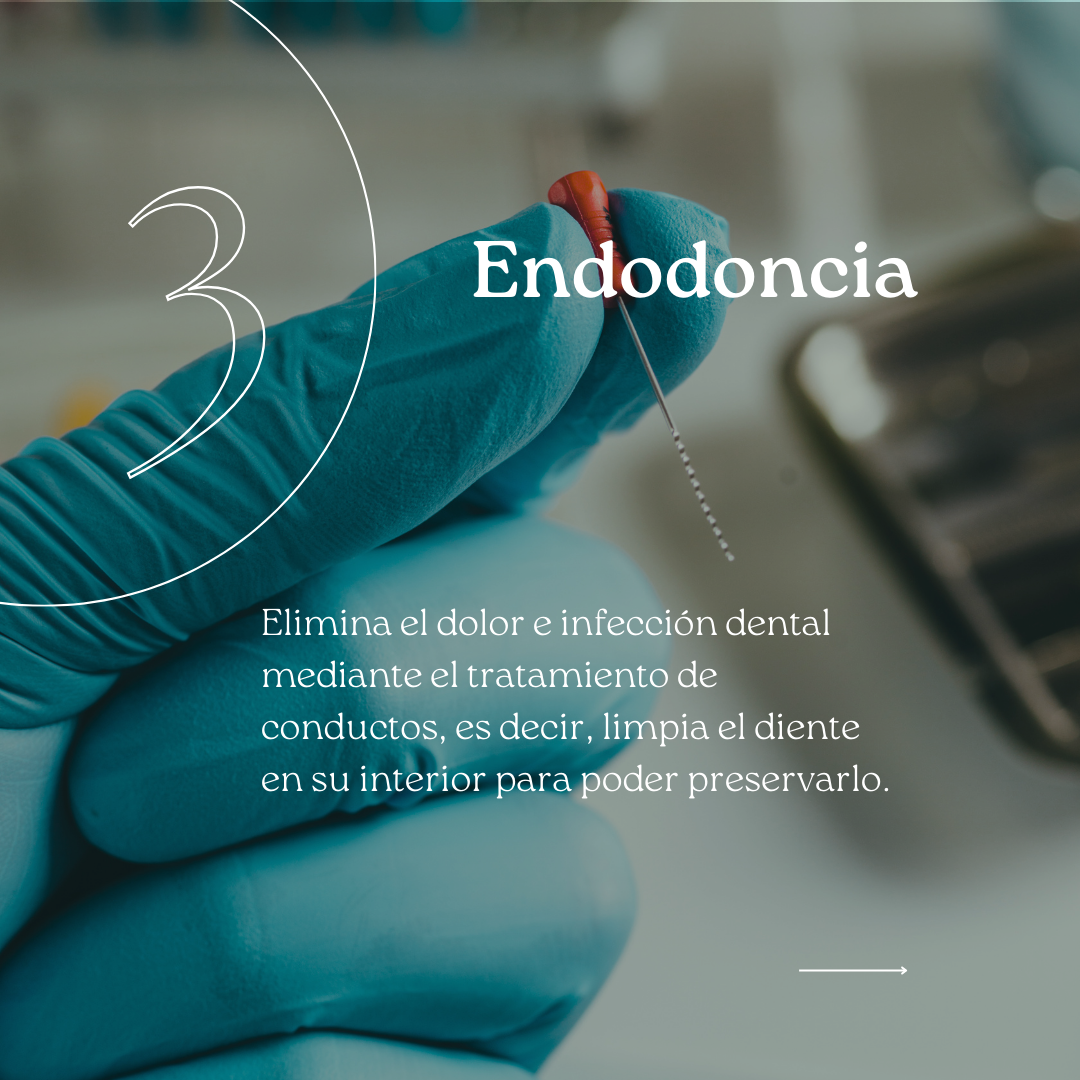 Todo lo que necesitas saber sobre la endodoncia: preguntas frecuentes